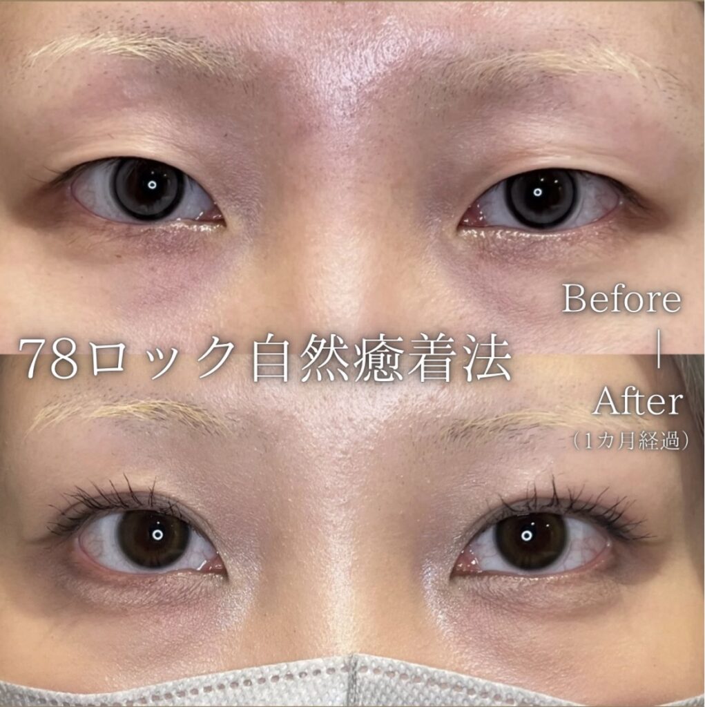 78ロック自然癒着法の症例5。上が施術前、下が1カ月後