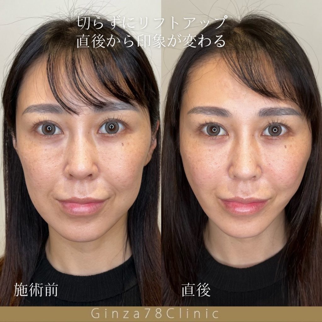 PDOスタンダード6本の症例。左が施術前、右が施術直後