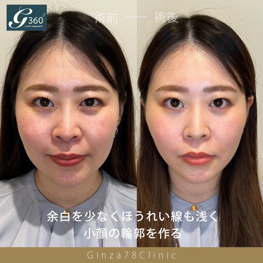 G-LIFT Flex12本の症例。左が施術前、右が施術後