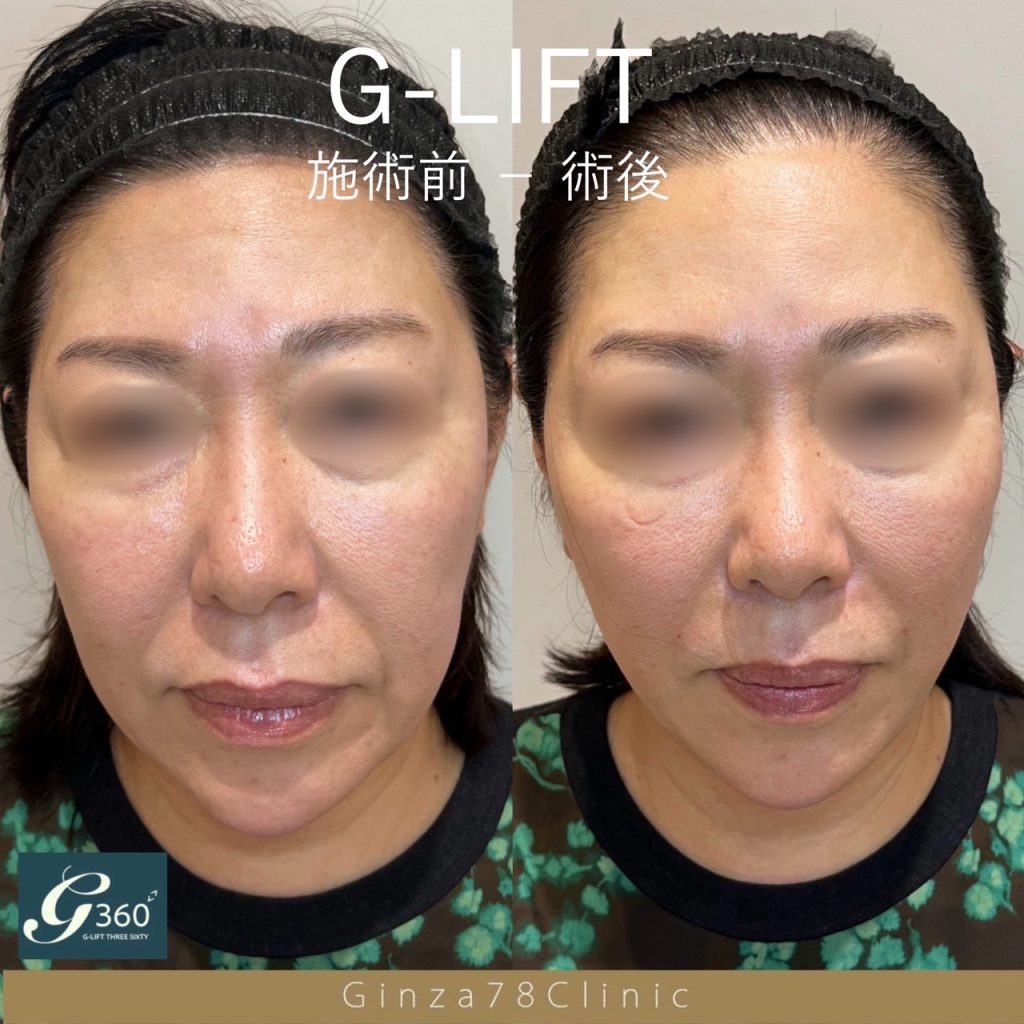 G-LIFTとヒアルロン酸を組み合わせた症例。左が施術前、右が施術後